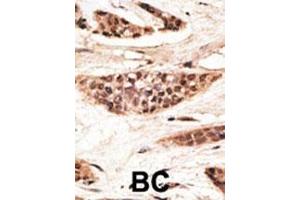 Formalin-fixed and paraffin-embedded human cancer tissue reacted with the primary antibody, which was peroxidase-conjugated to the secondary antibody, followed by AEC staining. (TAP1 抗体  (C-Term))