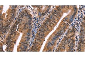 Immunohistochemistry of paraffin-embedded Human colon cancer using EVC2 Polyclonal Antibody at dilution of 1:40 (EVC2 抗体)