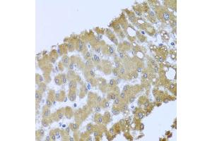 Immunohistochemistry of paraffin-embedded human liver injury using ACP1 antibody (ABIN6289983) at dilution of 1:100 (40x lens). (ACP1 抗体)