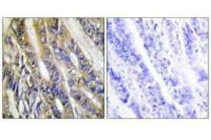 Immunohistochemistry analysis of paraffin-embedded human colon carcinoma tissue, using DGKH antibody. (DGKH 抗体)