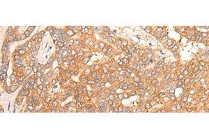 Immunohistochemistry of paraffin-embedded Human liver cancer tissue using CPS1 Polyclonal Antibody at dilution of 1:35(x200) (CPS1 抗体)