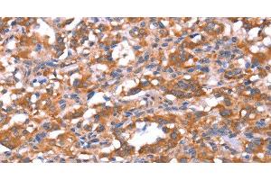 Immunohistochemistry of paraffin-embedded Human thyroid cancer tissue using FAM13B Polyclonal Antibody at dilution 1:30 (FAM13B 抗体)
