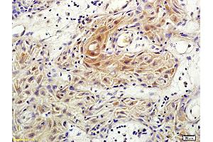 Formalin-fixed and paraffin embedded human vulvar cancer labeled with Anti-Rho C Polyclonal Antibody, Unconjugated (ABIN687157) followed by conjugation to the secondary antibody and DAB staining (RHOC 抗体  (AA 101-193))