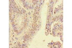 Immunohistochemistry of paraffin-embedded human colon cancer using ABIN7155138 at dilution of 1:100 (HNRNPA2B1 抗体  (AA 1-249))