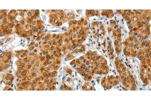 Immunohistochemistry of paraffin-embedded Human lung cancer tissue using COL1A2 Polyclonal Antibody at dilution 1:70 (COL1A2 抗体)