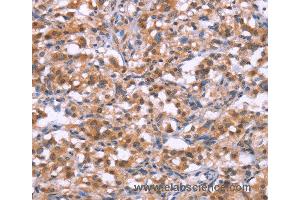 Immunohistochemistry of Human gastric cancer using BRK1 Polyclonal Antibody at dilution of 1:30 (BRK1 抗体)