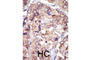 Formalin-fixed and paraffin-embedded human hepatocellular carcinoma tissue reacted with LYN polyclonal antibody  , which was peroxidase-conjugated to the secondary antibody, followed by AEC staining. (LYN 抗体  (N-Term))