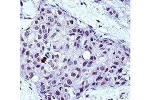 MYB antibody immunohistochemistry analysis in formalin fixed and paraffin embedded human breast carcinoma. (MYB 抗体  (AA 419-448))