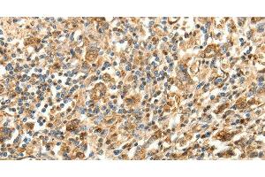 Immunohistochemistry of paraffin-embedded Human gastric cancer using SLC25A11 Polyclonal Antibody at dilution of 1:30 (SLC25A11 抗体)
