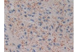 Detection of KLK2 in Human Glioma Tissue using Polyclonal Antibody to Kallikrein 2 (KLK2)