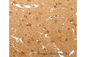Immunohistochemistry of Human lung cancer using MAP1B  Polyclonal Antibody at dilution of 1:60 (MAP1B 抗体)