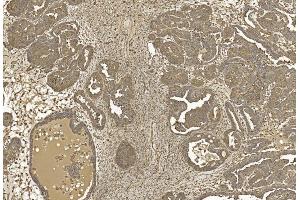 Immunohistochemical analysis of paraffin-embedded Human Ovarian cancer section using Pink1 am1021b. (beta Actin 抗体)