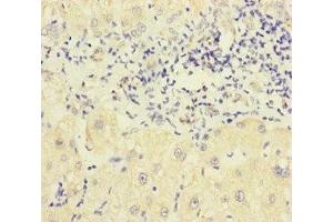 Immunohistochemistry of paraffin-embedded human liver cancer using ABIN7162443 at dilution of 1:100 (P2RX3 抗体  (AA 44-317))
