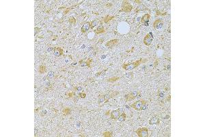 Immunohistochemistry of paraffin-embedded human brain cancer using CAMK1G Antibody (ABIN4903115) at dilution of 1:100 (40x lens).