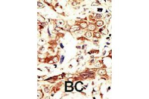 Formalin-fixed and paraffin-embedded human cancer tissue reacted with INSRR polyclonal antibody  , which was peroxidase-conjugated to the secondary antibody, followed by AEC staining. (INSRR 抗体  (C-Term))
