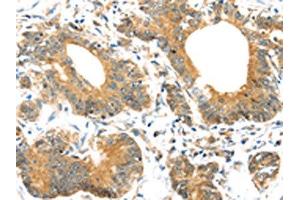 The image on the left is immunohistochemistry of paraffin-embedded Human colorectal cancer tissue using ABIN7192977(UBTD1 Antibody) at dilution 1/30, on the right is treated with synthetic peptide. (UBTD1 抗体)