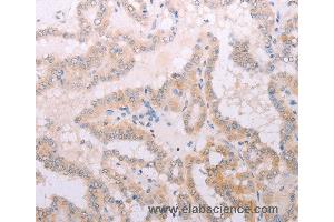 Immunohistochemistry of Human thyroid cancer using TPO Polyclonal Antibody at dilution of 1:50 (TPO 抗体)