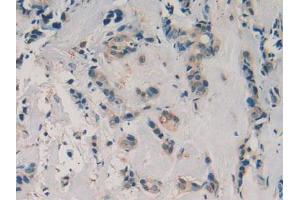 IHC-P analysis of Human Breast Cancer Tissue, with DAB staining. (AZGP1 抗体  (AA 180-298))