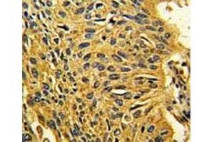 IHC analysis of FFPE human lung carcinoma stained with CDK2 antibody (CDK2 抗体  (AA 230-260))