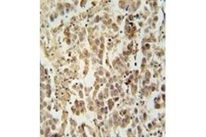 Immunohistochemistry analysis in formalin fixed and paraffin embedded human testis carcinoma reacted with LUZP4 Antibody (N-term) followed which was peroxidase conjugated to the secondary antibody and followed by DAB staining. (LUZP4 抗体  (N-Term))