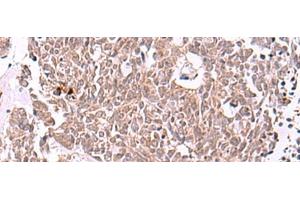 Immunohistochemistry of paraffin-embedded Human lung cancer tissue using IRX4 Polyclonal Antibody at dilution of 1:40(x200) (IRX4 抗体)