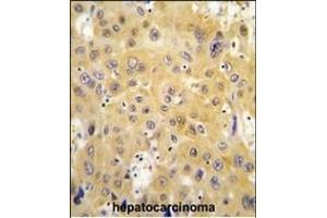 Formalin-fixed and paraffin-embedded human hepatocarcinoma tissue reacted with ECGF1 antibody (Center) (ABIN391460 and ABIN2841435) , which was peroxidase-conjugated to the secondary antibody, followed by DAB staining. (Thymidine Phosphorylase 抗体  (AA 318-345))