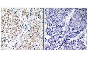 Immunohistochemical analysis of paraffin- embedded human breast carcinoma tissue using Myc (Ab-358) antibody (E021035). (c-MYC 抗体)