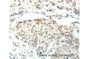 Immunohistochemistry of Human breast cancer using TPM2 Polyclonal Antibody at dilution of 1:60 (TPM2 抗体)