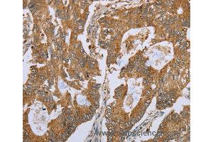 Immunohistochemistry of Human gastric cancer using NLRP10 Polyclonal Antibody at dilution of 1:45 (NLRP10 抗体)