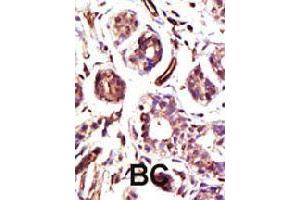 Formalin-fixed and paraffin-embedded human cancer tissue reacted with UBE3A polyclonal antibody  , which was peroxidase-conjugated to the secondary antibody, followed by DAB staining . (ube3a 抗体  (C-Term))