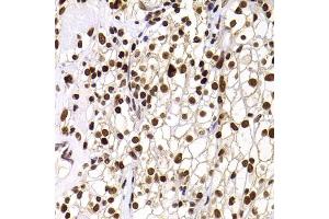 Immunohistochemistry of paraffin-embedded human kidney cancer using PHIP antibody (ABIN6129078, ABIN6145556, ABIN6145557 and ABIN6223036) at dilution of 1:100 (40x lens).