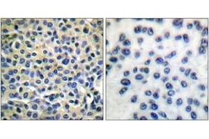 Immunohistochemistry analysis of paraffin-embedded human breast carcinoma tissue, using LIMK1/2 (Ab-508/505) Antibody. (LIMK-1/2 (AA 481-530) 抗体)