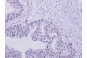 IHC-P Image ZNF45 antibody [N2C3] detects ZNF45 protein at nucleus on human colon carcinoma by immunohistochemical analysis. (ZNF45 抗体)