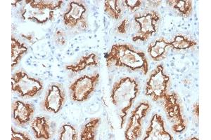 Formalin-fixed, paraffin-embedded human Renal Cell Carcinoma stained with RCC Rabbit Recombinant Monoclonal Antibody (CA9/2993R). (Recombinant CA9 抗体)