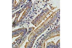 Immunohistochemical analysis of PIBF staining in human colon cancer formalin fixed paraffin embedded tissue section. (PIBF1 抗体)