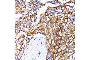 Immunohistochemistry of paraffin-embedded human liver cancer using Leptin Receptor Rabbit mAb (ABIN7268210) at dilution of 1:100 (40x lens). (Leptin Receptor 抗体)