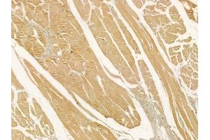 ABIN6262784 and ABIN6278914 at 1/100 staining human tongue carcinoma by IHC-P.