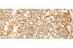 Immunohistochemistry of paraffin-embedded Human gastric cancer tissue using NR0B2 Polyclonal Antibody at dilution of 1:35(x200)