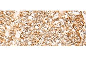 Immunohistochemistry of paraffin-embedded Human gastric cancer tissue using NR0B2 Polyclonal Antibody at dilution of 1:35(x200) (NR0B2 抗体)
