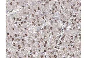 ABIN6267529 at 1/200 staining human liver cancer tissue sections by IHC-P. (SAPK, JNK (pTyr185) 抗体)