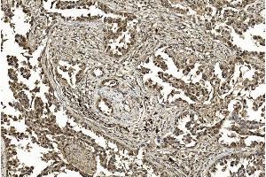 Immunohistochemical analysis of paraffin-embedded Human Lung adenocarcinoma section using Pink1 am1200a. (SUMO1 抗体)