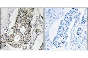 Immunohistochemistry analysis of paraffin-embedded human breast carcinoma tissue, using RIMS4 Antibody. (RIMS4 抗体  (AA 33-82))