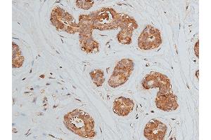 ABIN6269228 at 1/50 staining human breast cancer tissue by IHC-P. (VEGFR2/CD309 抗体)