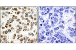 Immunohistochemistry analysis of paraffin-embedded human breast carcinoma tissue, using BRCA1 (Ab-1423) Antibody. (BRCA1 抗体  (AA 1391-1440))