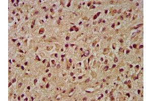 IHC image of ABIN7173964 diluted at 1:400 and staining in paraffin-embedded human glioma performed on a Leica BondTM system. (INPP5B 抗体  (AA 78-178))