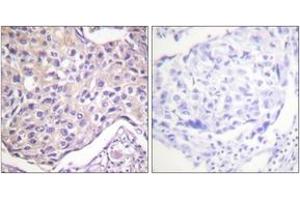 Immunohistochemistry analysis of paraffin-embedded human breast carcinoma, using GRK2 (Phospho-Ser29) Antibody. (GRK2 抗体  (pSer29))