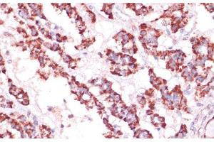 Immunohistochemistry of paraffin-embedded Human thyroid cancer using RPL24 Polyclonal Antibody at dilution of 1:100 (40x lens). (RPL24 抗体)