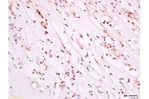 paraformaldehyde-fixed, paraffin embedded human breast carcinoma tissue, Antigen retrieval by boiling in sodium citrate buffer(pH6) for 15min, Block endogenous peroxidase by 3% hydrogen peroxide for 30 minutes, Blocking buffer (normal goat serum) at 37°C for 20min, Antibody incubation with Rabbit Anti-PDK1 (Ser241) Polyclonal Antibody, Unconjugated  at 1:500 overnight at 4°C, followed by a conjugated secondary and DAB staining (PDPK1 抗体  (pSer241))