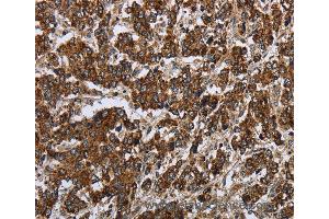 Immunohistochemistry of Human liver cancer using PPP1R13L Polyclonal Antibody at dilution of 1:30 (PPP1R13L 抗体)