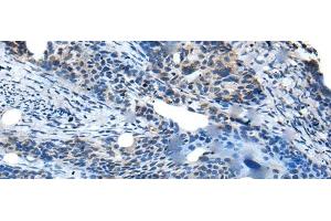 Immunohistochemistry of paraffin-embedded Human cervical cancer tissue using SAA4 Polyclonal Antibody at dilution of 1:35(x200) (SAA4 抗体)
